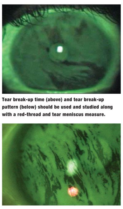 tear assessment test|tear break up time.